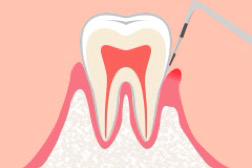 歯周基本検査
