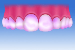歯周組織検査染め出し